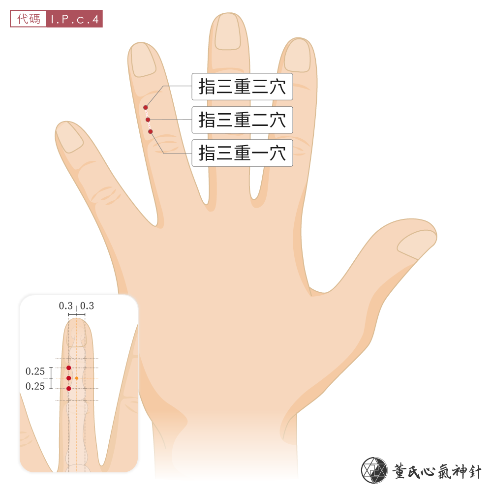 指三重穴位於無名指背面指三重區左手示意圖