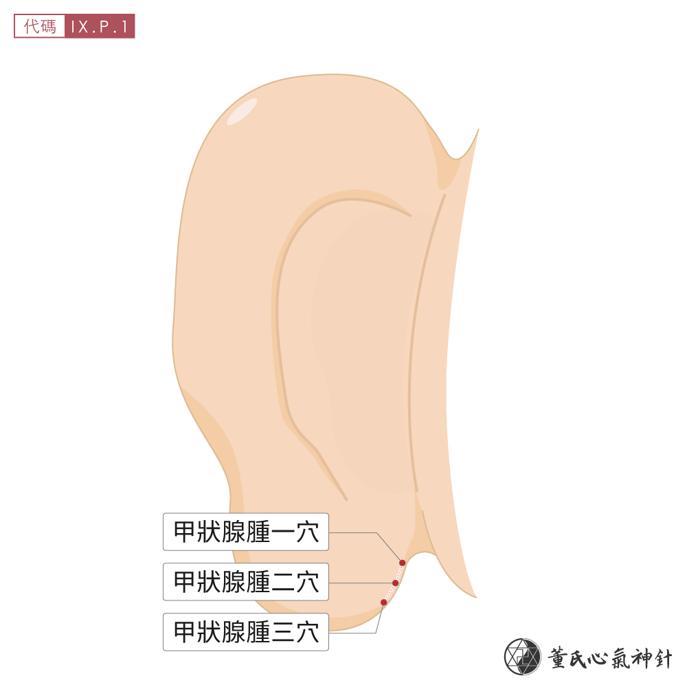甲狀腺腫穴位於耳朵後側甲狀腺腫區示意圖